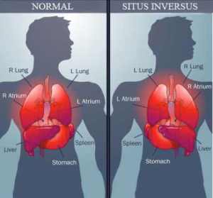 situs-inversus-medicina-bizara